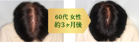 60代女性 約3ヶ月後