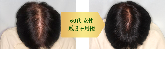 60代女性 約3ヶ月後