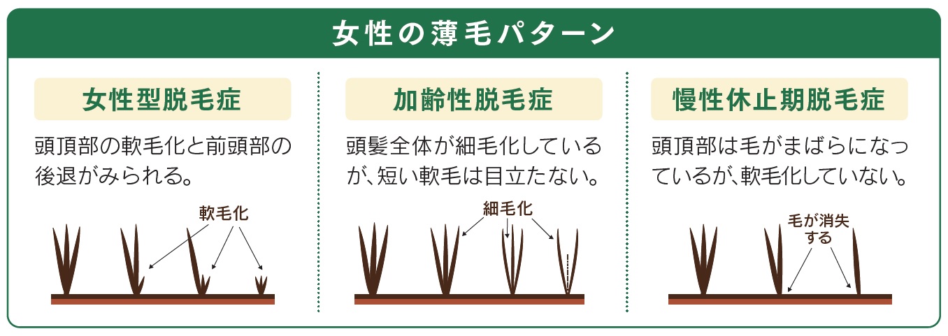 女性の薄毛パターン