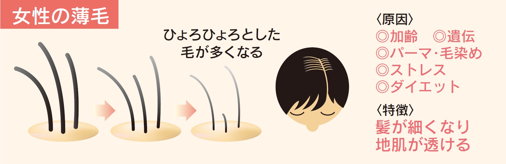 女性の薄毛（女性型脱毛症）